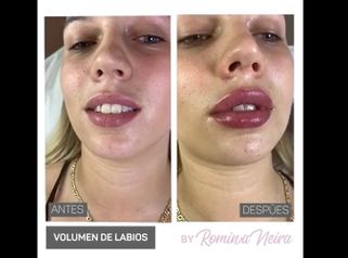 Relleno de labios