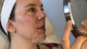 Tratamiento Ojeras - Antes y después - Dra. Romina Neira