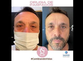 Blefaroplastia - Dr. Sebastián Gallo