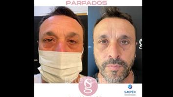 Blefaroplastia - Dr. Sebastián Gallo