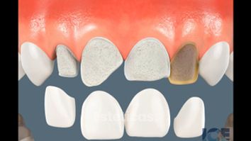 Porcelain Veneers