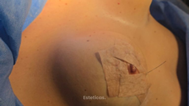 Mastopexia estructurada en L - Dra. Natalia Solimano