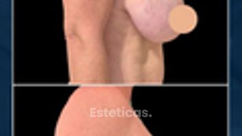 Reducción de Mamas - Dr. Damián Wengrowicz