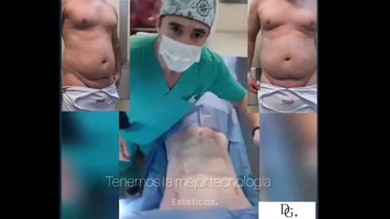 Liposucción - Dr. Damián Galeazzo