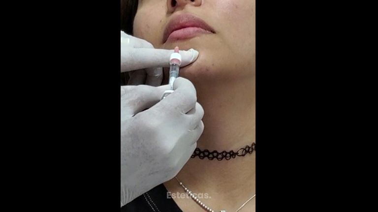 Relleno de labios - Dra. Cristina G. Lazarte