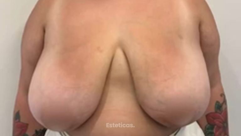 Reducción de mamas - Dr. Fernando Glaria