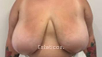 Reducción de mamas - Dr. Fernando Glaria