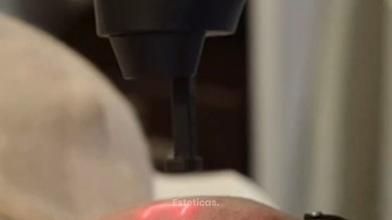 Laser CO2 - Dra. Mariana Bouveir