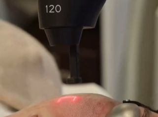 Laser CO2 - Dra. Mariana Bouveir