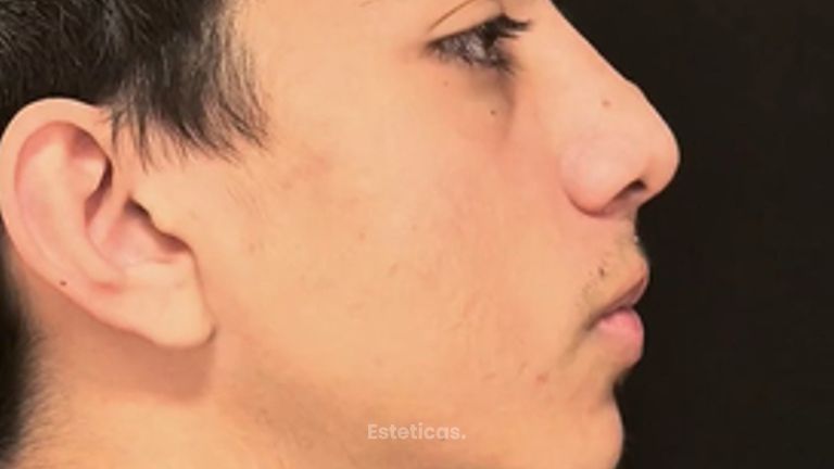 Rinoplastia - Dr. Damián Wengrowicz