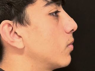 Rinoplastia - Dr. Damián Wengrowicz