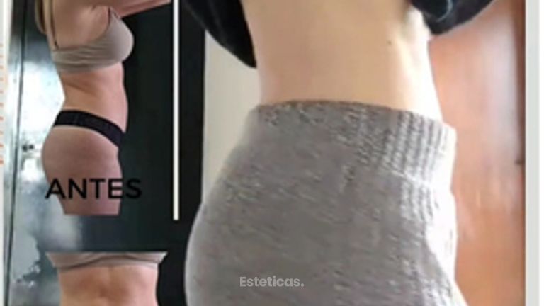 Lipoescultura HD - Dra. Paula Granero