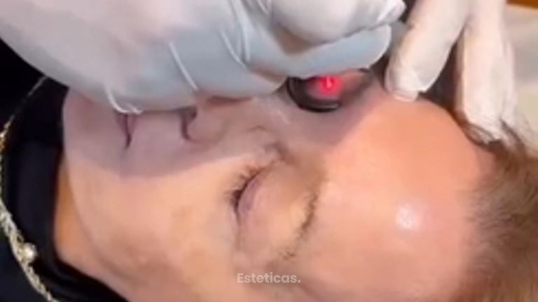 Blefaroplastia - Dr. Agustín Matia