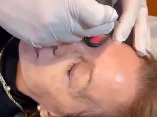 Blefaroplastia - Dr. Agustín Matia