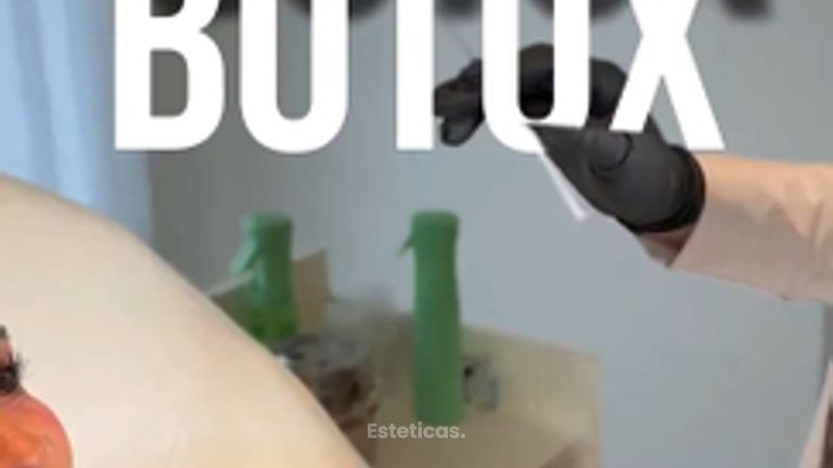 Toxina botulínica con expresión natural | Alma Estética Belgrano