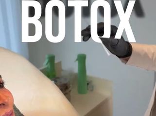 Toxina botulínica con expresión natural | Alma Estética Belgrano