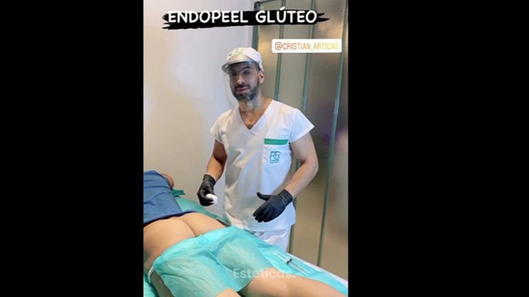 Endopeel glúteo - Dr. Franco Gomez