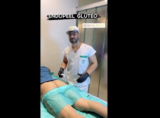 Endopeel glúteo - Dr. Franco Gomez