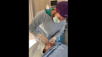 Liposucción de papada - Dr. Emmanuel Manavela Chiapero