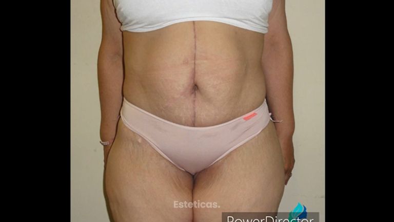 Abdominoplastia - Dr. Rodolfo Villavicencio