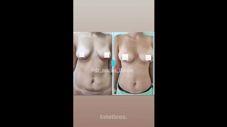 Liposucción - Dr. Matías Llabres
