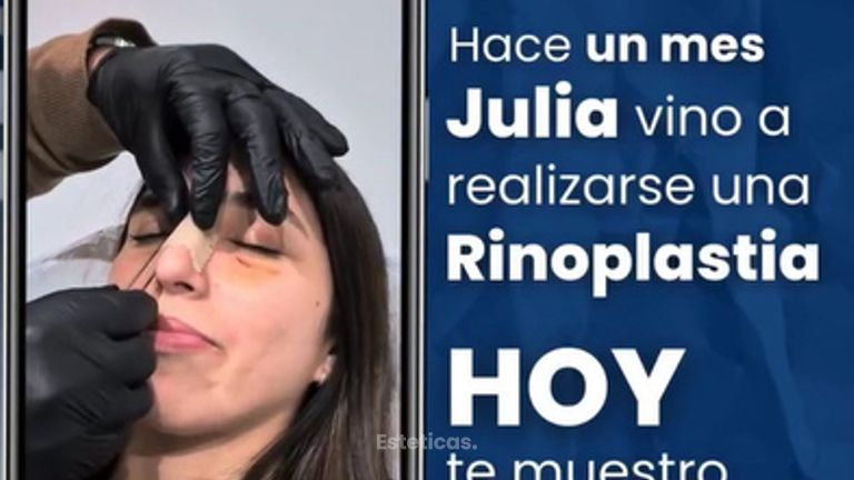 Rinoplastia - Dr. Damián Wengrowicz