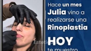 Rinoplastia - Dr. Damián Wengrowicz