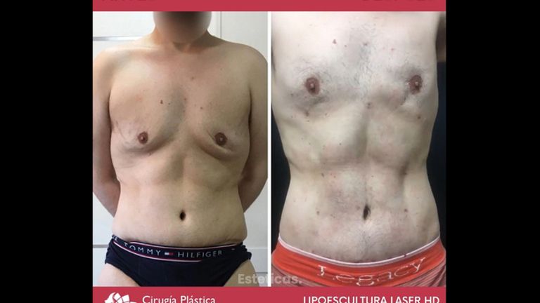 Lipoescultura - Dr. Emmanuel Manavela Chiapero