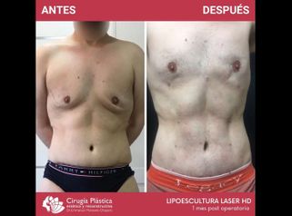 Lipoescultura - Dr. Emmanuel Manavela Chiapero