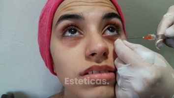 Eliminación de Ojeras