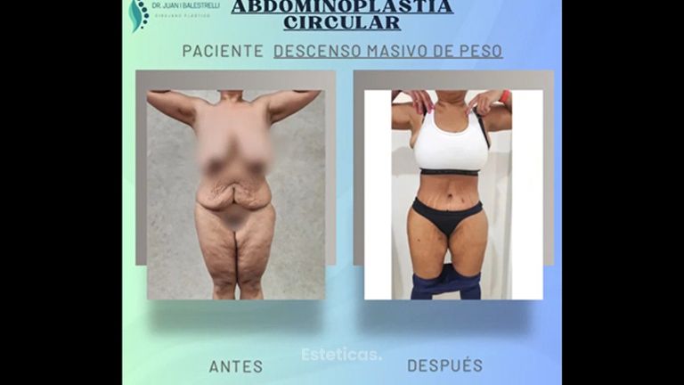 Abdominoplastia - Dr. Juan Ignacio Balestrelli