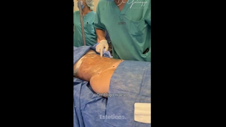 Liposucción - Dr Damián Galeazzo y Equipo