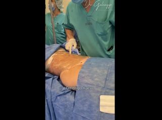 Liposucción - Dr Damián Galeazzo y Equipo