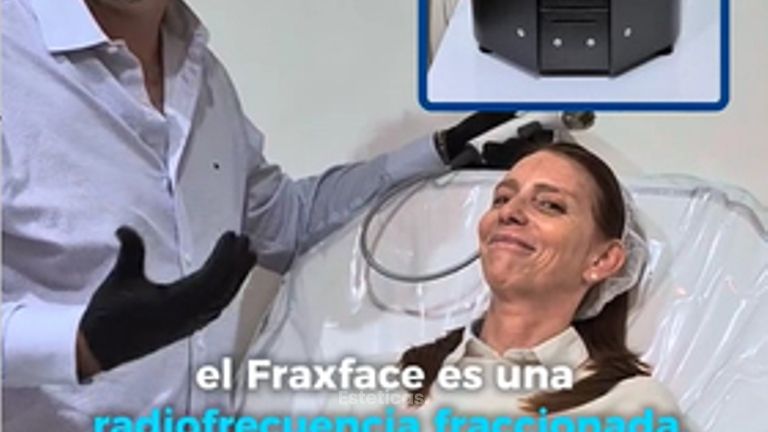 Fraxface Radiofrecuencia facial -Dr. Damián Wengrowicz
