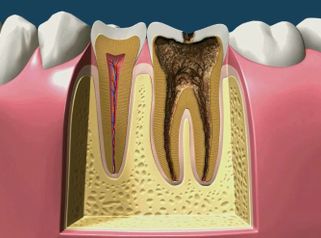 Carie Evolution o evolucion de la caries dental advance