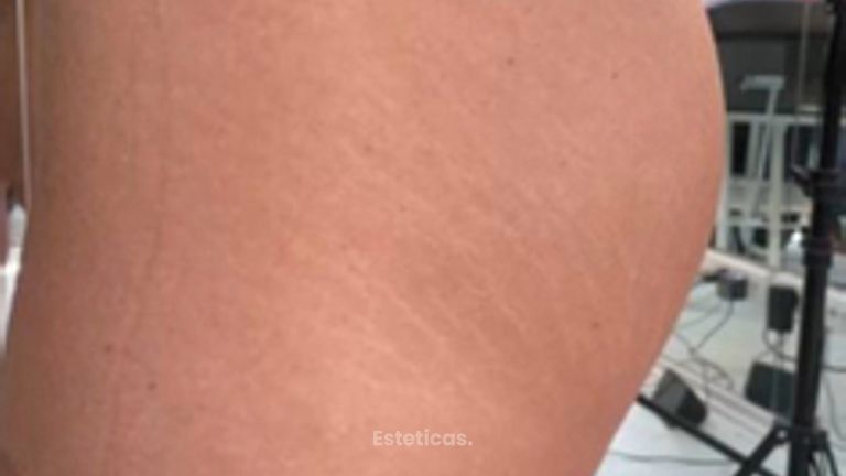 Hilos glúteos - Escobar Aesthetic Clinic