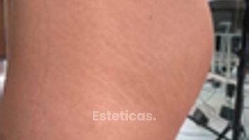 Hilos glúteos - Escobar Aesthetic Clinic