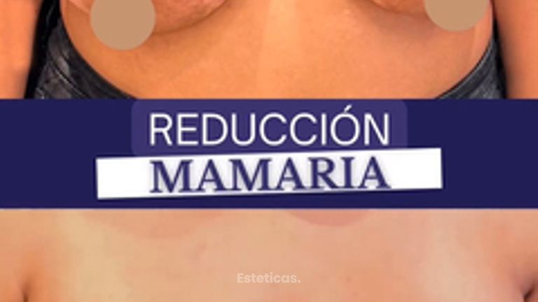 Reducción de mamas - Dr. Agustín Matia