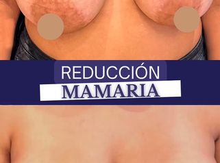 Reducción de mamas - Dr. Agustín Matia