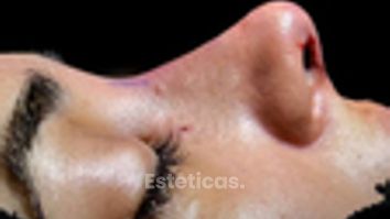 Rinoplastía estructural -  Dr. Sebastian Gallo
