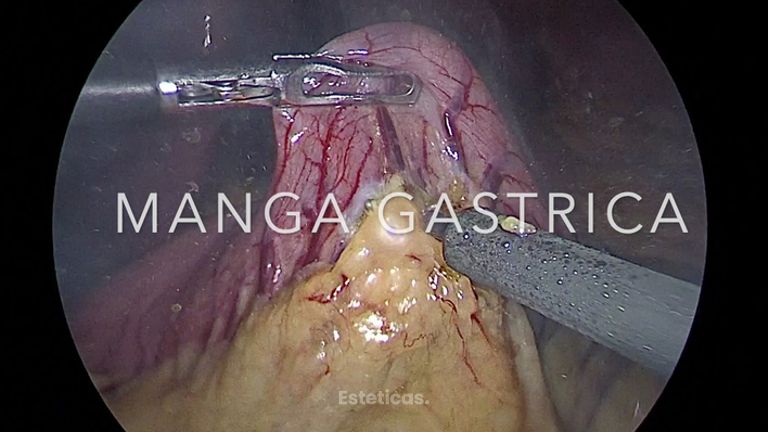 Manga Gástrica