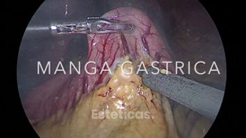 Manga Gástrica