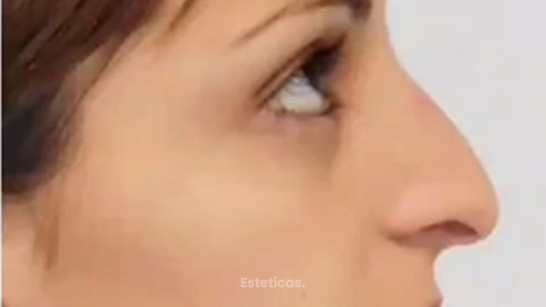 Rinoplastia - Dr. Gabriel Mirave