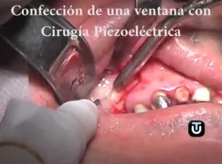 Las mejores soluciones para tu dentadura
