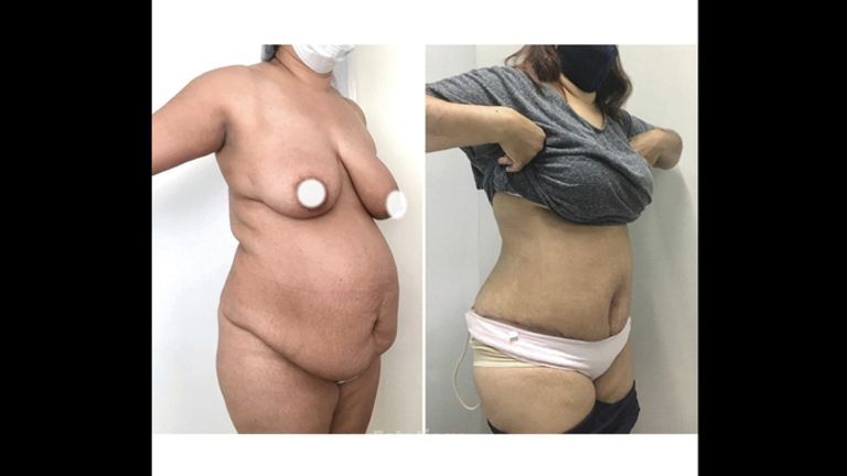 Abdominoplastia - Dr. Ariel Ignacio García