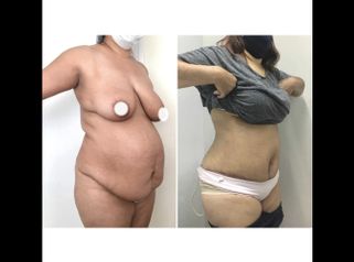 Abdominoplastia - Dr. Ariel Ignacio García