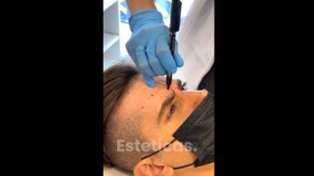 Dysport. marcación + aplicación - Dra. Laura Marin