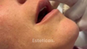 Relleno de labios - Dr. Agustín Matia