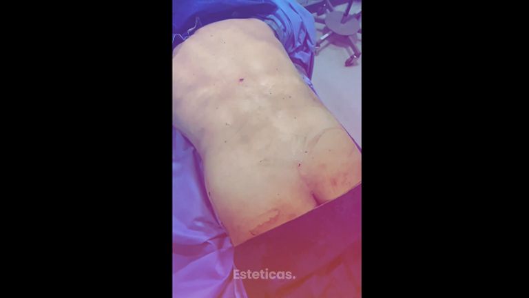 Liposucción - Dra. Paola León