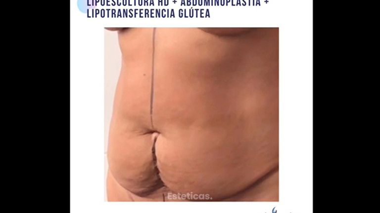Lipoescultura HD + abdominoplastia + lipotransferencia glútea